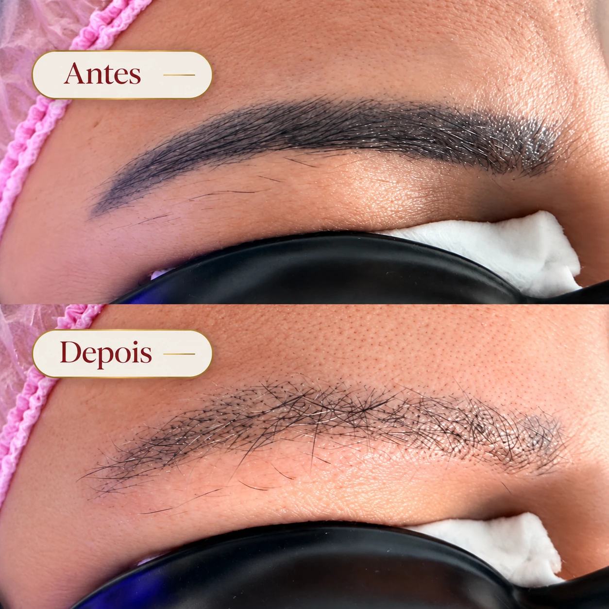 Antes e depois da despigmentação de sobrancelha
