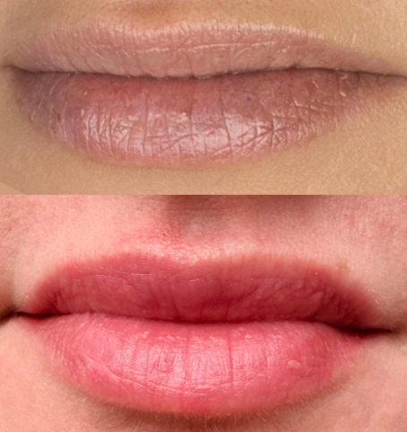 Antes e depois de micropigmentação labial Eva Derm