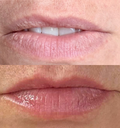 Natural Lips — antes e depois