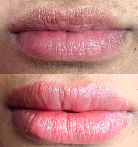 Neutralização Indireta — antes e depois